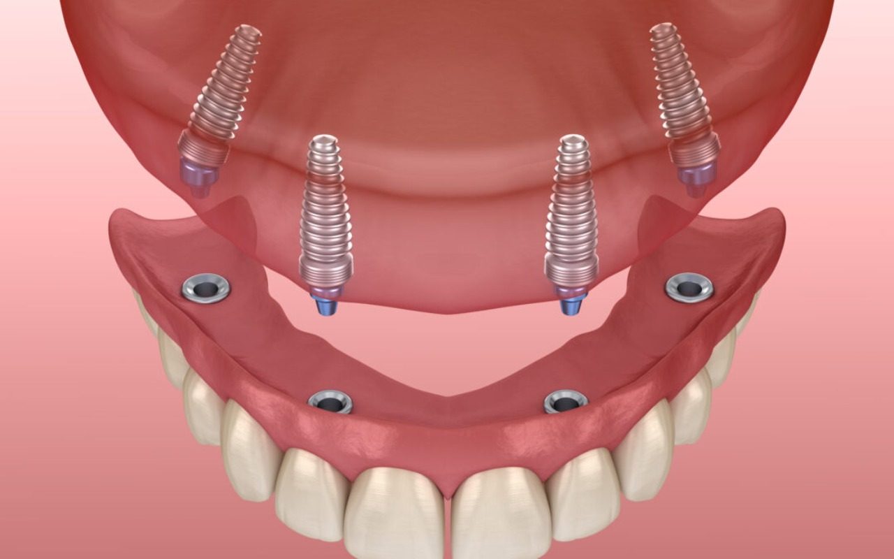 What the All-on-4 Procedure Actually Involves